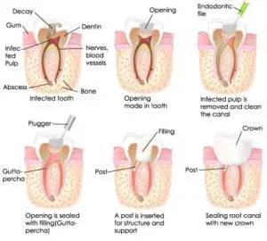 root canal treatment