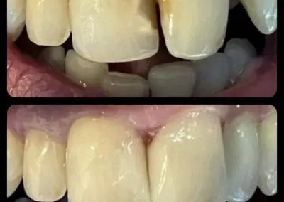 teeth6