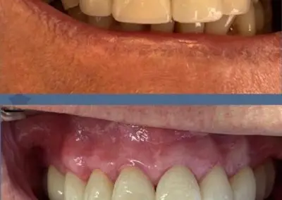 teeth4