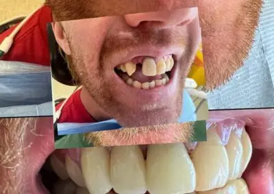 teeth9